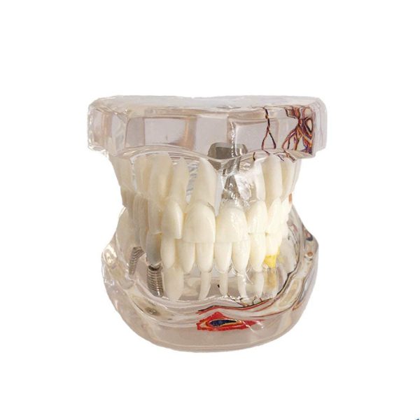 YOUYA DENTAL Neural Repair Dental Implant Disease Teeth Model Dentist Standard Pathological Removable Teeth Teaching Model - Image 4