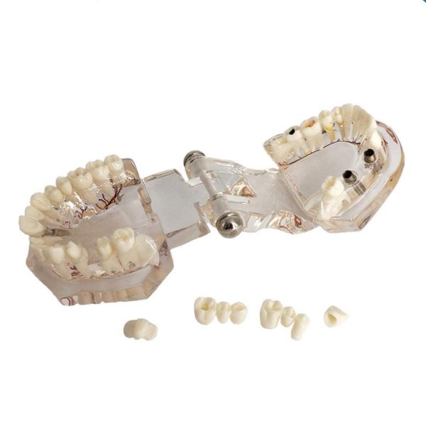 YOUYA DENTAL Neural Repair Dental Implant Disease Teeth Model Dentist Standard Pathological Removable Teeth Teaching Model - Image 6