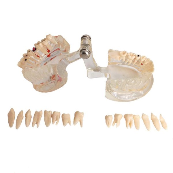 YOUYA DENTAL Neural Repair Dental Implant Disease Teeth Model Dentist Standard Pathological Removable Teeth Teaching Model - Image 7