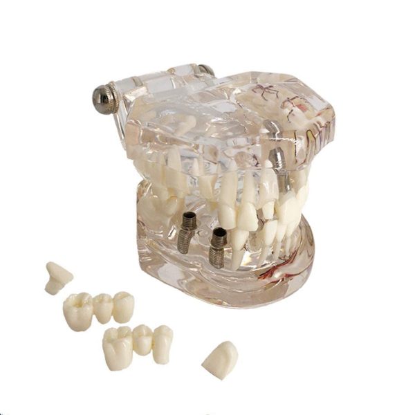 YOUYA DENTAL Neural Repair Dental Implant Disease Teeth Model Dentist Standard Pathological Removable Teeth Teaching Model - Image 5