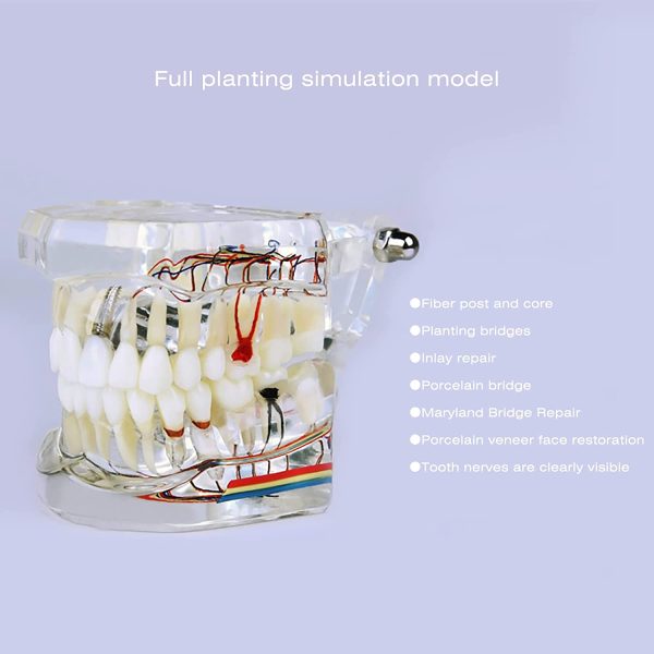 YOUYA DENTAL Neural Repair Dental Implant Disease Teeth Model Dentist Standard Pathological Removable Teeth Teaching Model - Image 3