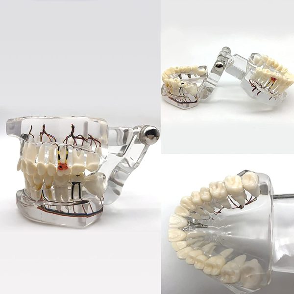 YOUYA DENTAL Neural Repair Dental Implant Disease Teeth Model Dentist Standard Pathological Removable Teeth Teaching Model - Image 2