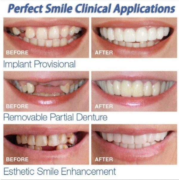 Braces Snap On Perfect Smile Instant Veneers Dentures Fake Teeth Smile Serrated Denture Teeth Top and Bottom Comfort Fit Flex Teeth Socket to Make White Tooth Beautiful Neat - Image 7