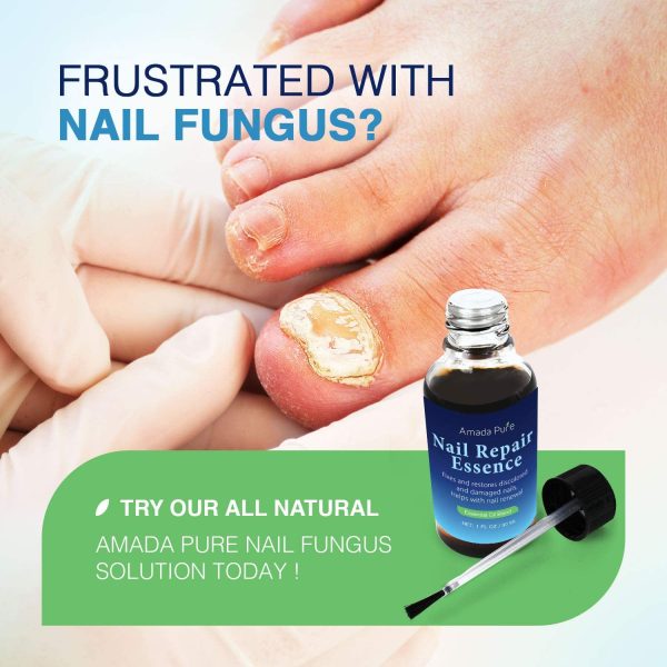 Amada Pure Fungus Stop, Fungus Nail Care Solution ?CToenail & Fingernail Fungus Remover, Restores Discolored & Damaged Nails to a Healthy Appearance, Safe (30ml) - Image 2