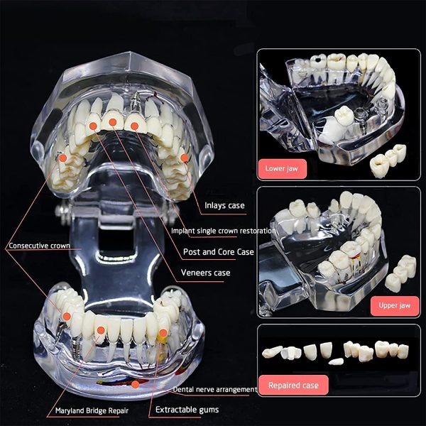 YOUYA DENTAL Neural Repair Dental Implant Disease Teeth Model Dentist Standard Pathological Removable Teeth Teaching Model