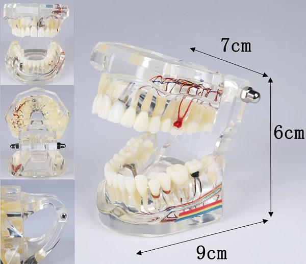 YOUYA DENTAL Neural Repair Dental Implant Disease Teeth Model Dentist Standard Pathological Removable Teeth Teaching Model - Image 9