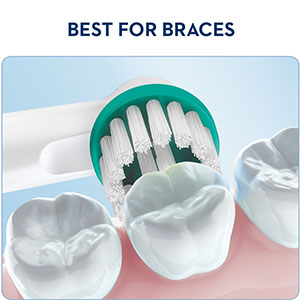 Best for Braces