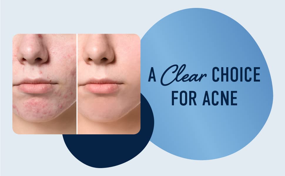 A clear choice for acne