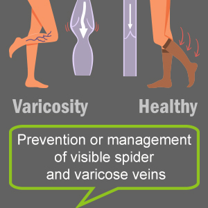 varicose veins